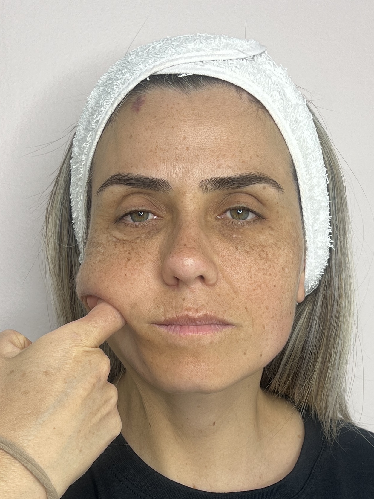 Nuze depois do bioestimulador de colágeno